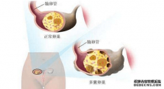 <b>多囊怀孕以后，是不是就代表彻底好了？</b>