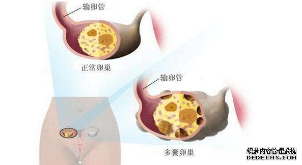 多囊怀孕以后，是不是就代表彻底好了？